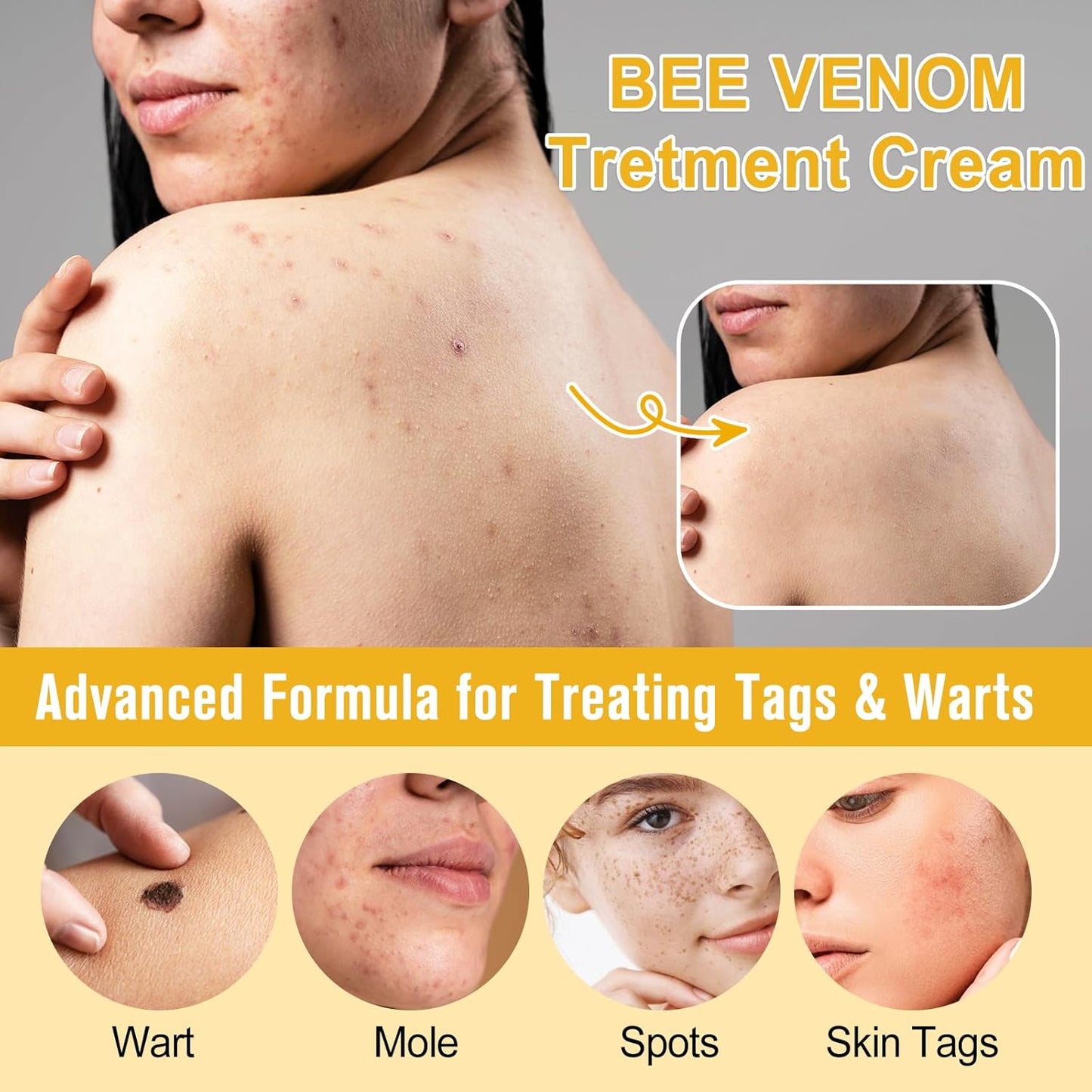 Bee Venom Moles and Warts Removal Cream