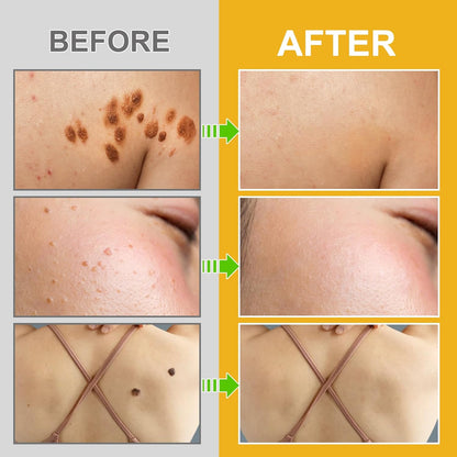 Bee Venom Moles and Warts Removal Cream