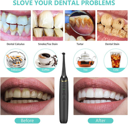 Electric Dental Calculus Remover Tooth Cleaner