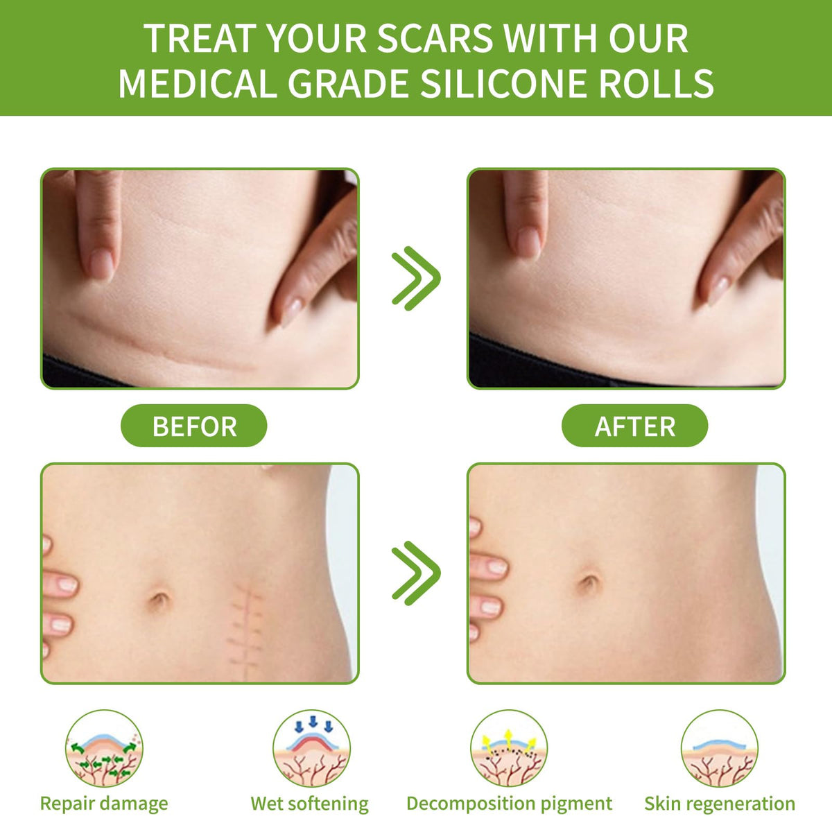 Silicone Scar Sheets